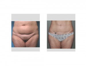 Long term Tummy Tuck result front view Dr Barry Eppley Indianapolis