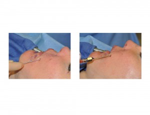 Microliposuction and Fat Grafting for Injectable Filler Nodules Dr Barry Eppley Indianapolis