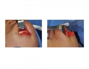 Muscle Resuspension in Submental Chin Ptosis Correction Dr Barry Eppley Indianapolis