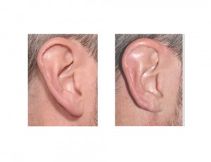 Right Helical Rim Earlobe Reduction result Dr Barry Eppley Indianapolis