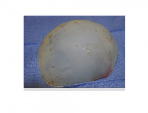 Skull Implant Perfusion Holes Dr Barry Eppley Indianapolis