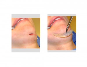 Small Chin Implant Incision Dr Barry Eppley Indianapolis