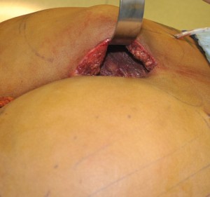 Subfascial Buttock Implants Dr Barry Eppley Indianapolis