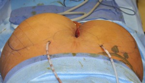 Subfascial Buttock Implants Indianapolis Dr Barry Eppley
