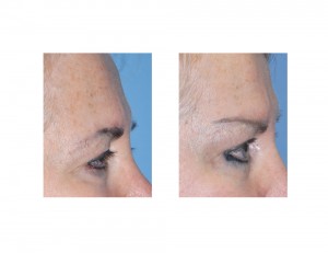 Temporal Browlift results side view Dr Barry Eppley Indianapolis