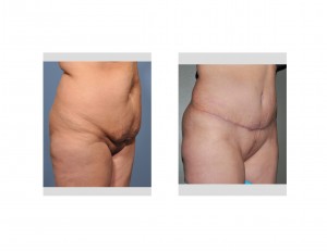 Tummy Tuck abdominal reshaping Dr Barry Eppley Indianapolis