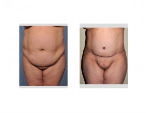Tummy Tuck results front view Dr Barry Eppley Indianapolis