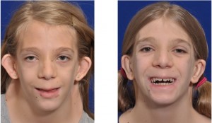Webbed Neck and Otoplasty Correction result