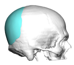 custom occipital implant design side view jm