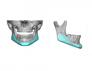 Custom Jawline Implant Dr Barry Eppley Indianapolis