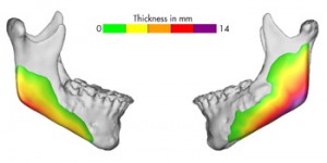 Custom Jawline Implant Thicknesses Dr Barry Eppley Indianapolis