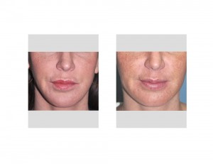 Custom Jawline Implants for Facial Reconstruction after Orthognathic Surgery Dr Barry Eppley Indianapolis