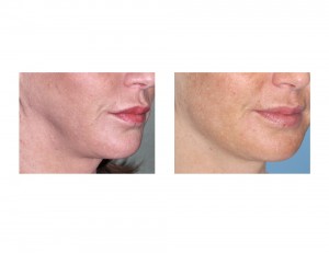 Custom Jawline Implants for Facial Reconstruction after Orthognathic Surgery oblique view Dr Barry Eppley Indianapolis