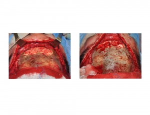 Frontal Sinus HA Removal with Central Nasal Communication Dr Barry Eppley Indianapolis