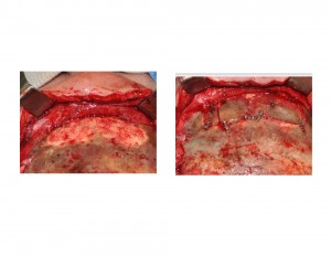 Frontal Sinus Reconstruction with Cranial Bone Grafts Dr Barry Eppley Indianapolis