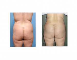 Intramuscular Buttock Implants back view Dr Barry Eppley Indianapolis