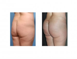 Intramuscular Buttock Implants right side view Dr Barry Eppley Indianapolis