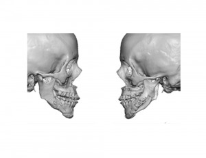 Jawline Defects after Orthognathic Surgery Dr Barry Eppley Indianapolis