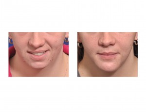 Sliding Genioplasty result front view