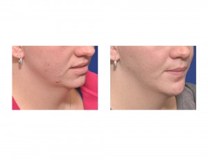 Sliding Geniop[lasty result oblique view