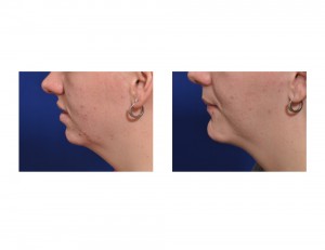 Sliding Genioplasty result side view