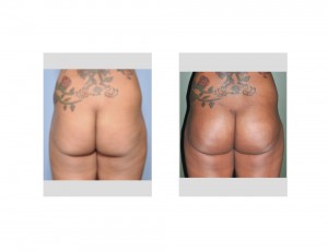 Subfascial Buttock Implants result back view
