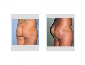 Subfascial Buttock Implants result right oblique view