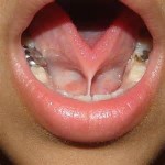 Tongue Tie Release Surgery Dr Barry Eppley Indianapolis