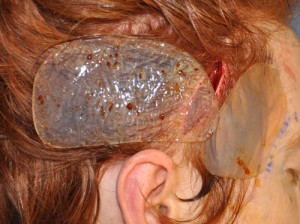 Anterior and Posterior Temporal Implants for Head Widening Dr Barry Eppley Indianapolis