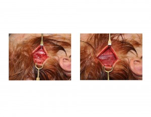 Anterior and Posterior Temporal Implants for Head Widening Placement Technique Dr Barry Eppley Indianapolis
