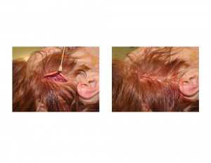 Anterior and Posterior Temporal Implants for Total Head Widening Surgical Technique Dr Barry Eppley Indianapolis