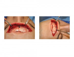Bone Flap Fixation Nerve Sparing Brow Bone Reduction Technique Dr Barry Eppley Indianapolis