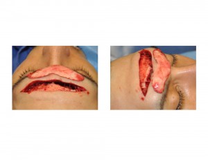 Bone Flap Removal in Nerve Sparing Brow Reduction Technique Dr Barry Eppley Indianapolis