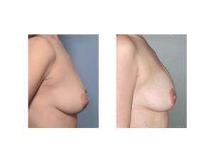 Breast Fat Injectiions result side view Dr Barry Eppley Indianapolis