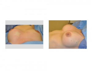 Breast Fat Injections intraop result Dr Barry Eppley Indianapolis