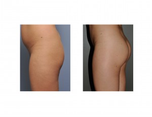 Buttock Augmentation results left side view. DR Barry Eppley Indianapolis