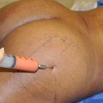 Buttock Fat Injections Dr Barry Eppley Indianapolis