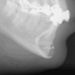 Chin Implant Settling (Erosion) Dr Barry Eppley Indianapolis