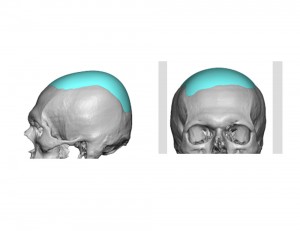 Custom Skull Cap Implant design Dr Barry Eppley
