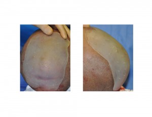 Custom Skull Cap Implant placement on skull Dr Barry Eppley Indianapolis