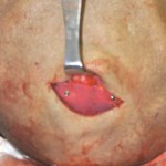 Custom Skull Cap Implant placement with screw fixation Dr Barry Eppley Indianapolis