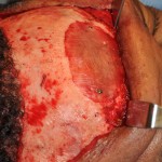 Forehead Narrowing with Glabellar Implant Dr Barry Eppley Indianapolis