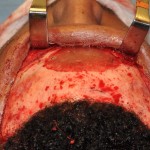 Glabellar Augmentation in Forehead Dr Barry Eppley Indianapolis