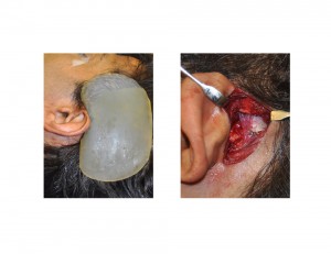 Head Widening (Temporal) Implants Surgical Technique Implant Placement Dr Barry Eppley Indianapolis