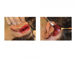 Head Widening (Temporal) Implants Surgical Technique Incision and Pocket Dissection Dr Barry Eppley Indianapolis