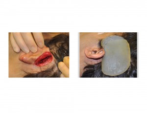 Head Widenng Implant Surgical Technique Dr Barry Eppley Indianapolis