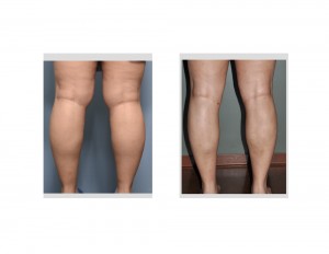 Knee and Calf Liposuction result back view