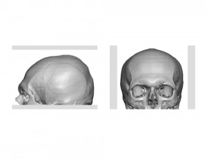 Lumpy Misshapen Skull Dr Barry Eppley Indianapolis