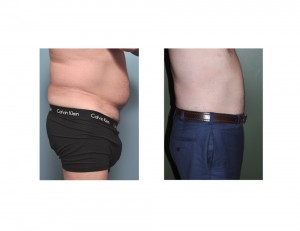 Male Abdomina Flank Liposuction result side view Dr Barrty Eppley Indianapolis