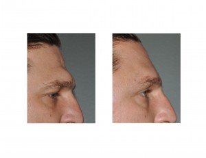 Male Brow Bone Reduction Dr Barry Eppley Indianapolis